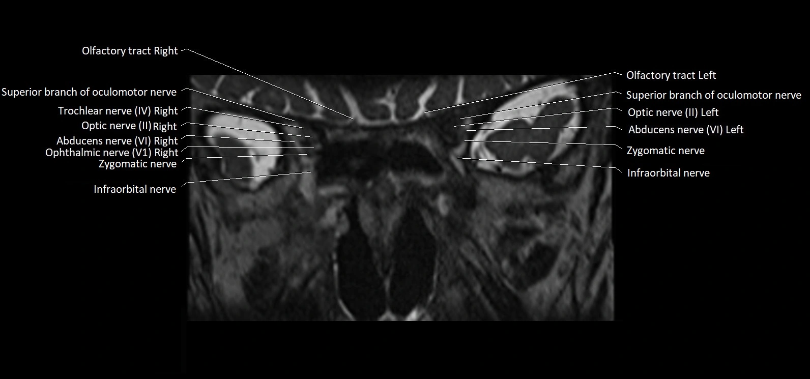 Cranial nerve cross sectional anatomy coronal 3T MRI image 15.webp